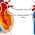 Leaky heart valve